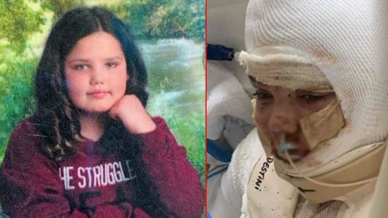 Korkunç olay! Tiktok`taki alkolle yazı yazma akımına katılan 13 yaşındaki kız çocuğu, alevler içerisinde kaldı