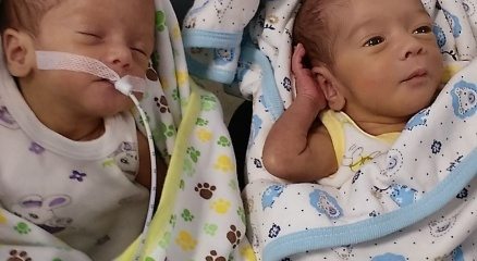 7 aylık doğan ikizler sağlığına kavuştu