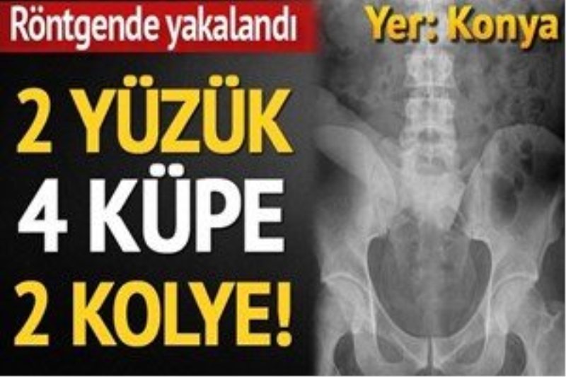 Azılı hırsız, çaldıklarını yutmuş!..